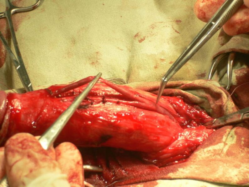 липофилинг на пениса за уголемяване