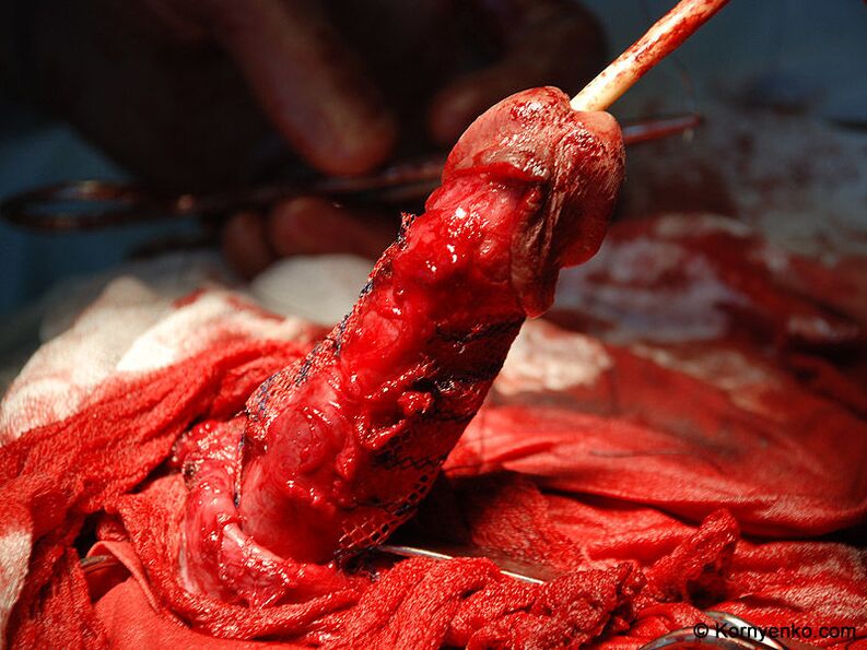 поставяне на колагенова матрица за уголемяване на пениса