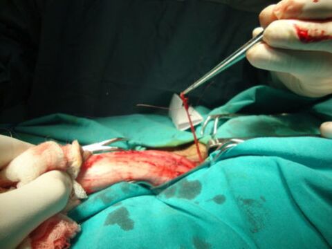 операция за уголемяване на пениса