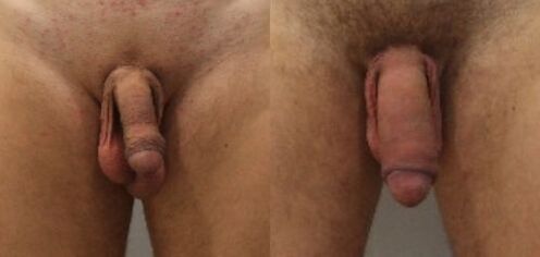 преди и след операция за уголемяване на пениса