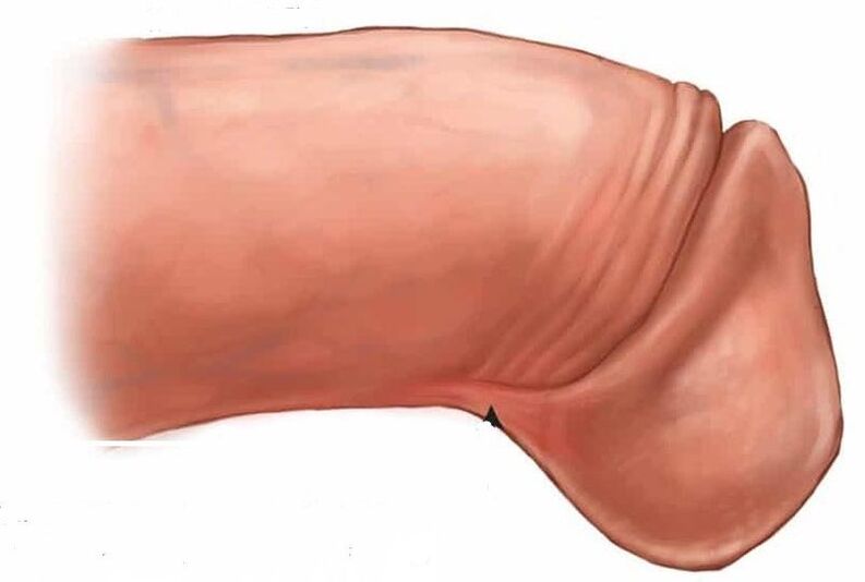 как да увеличите главичката на пениса